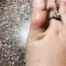 Angel Nails - Chemical burn picture that I took while at the salon