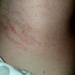 Hand & Stone Massage and Facial Spa - Scratches left by masseuse with her long sharp fingernails!!!!!!!