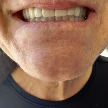 Blash Dentistry - Upper four unit bridge completed - Cosmetic Dentists Near Me - Corona, California