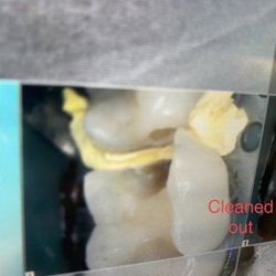 Moonlight Beach Dental - Conserving as much as the tooth as possible, We prepared the tooth for an onlay instead of a crown.