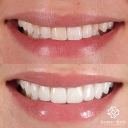 Robert Soto, DDS - Natural looking porcelain veneers with no shaving!