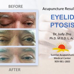 Sunrise Acupuncture Medical Center - Great results on an eyelid ptosis case showing full recovery after acupuncture treatment.