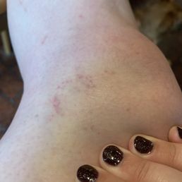 Bruises left from the waxing. Bruises left from the waxing.