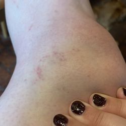L'amour Nails & Spa - Bruises left from the waxing.