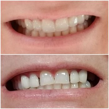 New Day Smile - Here is my before (bottom) and after (top)! Im so happy! - Cosmetic Dentists Near Me - La Mesa, California New Day Smile - Here is my before (bottom) and after (top)! Im so happy! - Cosmetic Dentists Near Me - La Mesa, California