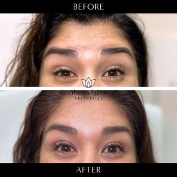Ethereal Glow Aesthetics - Beautiful results from forehead and frown line tox treatment. - Medical Spas Near Me - Mountain View, California Ethereal Glow Aesthetics - Beautiful results from forehead and frown line tox treatment. - Medical Spas Near Me - Mountain View, California