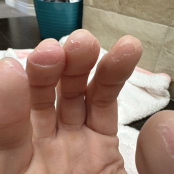 Forefront Dermatology - Englewood - Peeling fingers. Never picked at ever - Dermatologists Near Me - Englewood, Colorado Forefront Dermatology - Englewood - Peeling fingers. Never picked at ever - Dermatologists Near Me - Englewood, Colorado