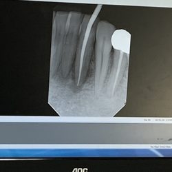 A-Dental Center - Root canal