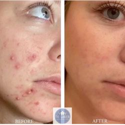 The Garden Medical Spa - Hydrafacial and chemical peel