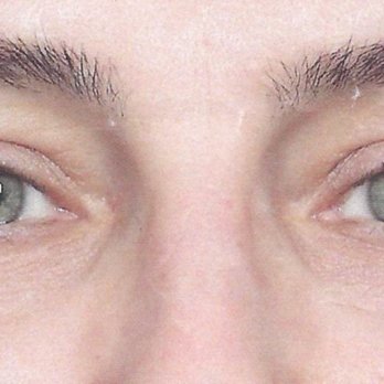 Marina Plastic Surgery - Upper lid after - Medical Spas Near Me - Los Angeles, California Marina Plastic Surgery - Upper lid after - Medical Spas Near Me - Los Angeles, California