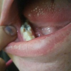 MyMichigan Medical Center - Clare - Just so u know I'm not faking it. There's my infected, chipped, throbbing in pain tooth.