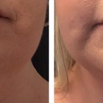 Advanced Skin and Body Solutions - Initial consultation before CoolSculpting, then after 30 days (3 total - one on the left side, one in the center, and one on the left side) - Medical Spas Near Me - Bellevue, Washington