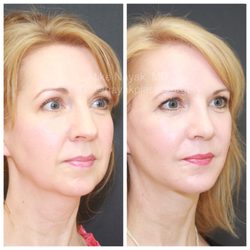 Nayak Plastic Surgery - 6 weeks post Deep Necklift, Deep Plane Facelift, Rhinoplasty, Buccal Fat Removal and Chin Implant