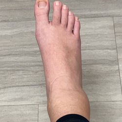 North Alabama Medical Center - Rotten toe soil foot wait too long, sac a glace melt