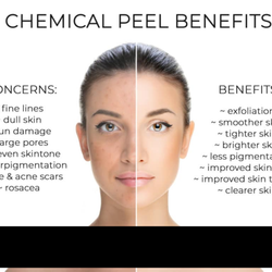 Peels can be used alone or together with other treatments for better results. Stacking treatments are my specialty ;)