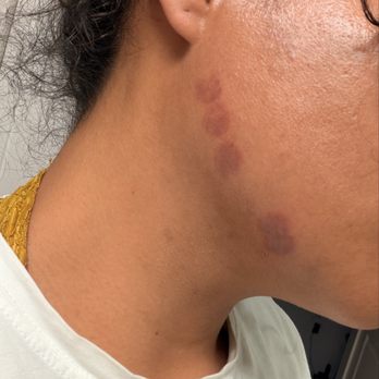 LaserAway Reno - 1st day after treatment Saturday July 11th - Laser Hair Removal Near Me - Reno, Nevada
