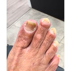 Wellness Pedicures By Jay - Medical Pedicure Diabetic patient. Before