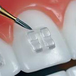Rawle Orthodontics - Rawle Orthodontics Specializes In Clear Brackets