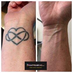 DISAPPEARING inc - Placement is everything. We removed this infinity heart from our client's wrist.