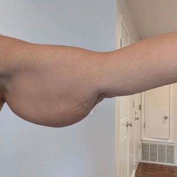 Eric P Bachelor, MD, FACS - Before brachioplasty. - Cosmetic Surgeons Near Me - Pleasanton, California