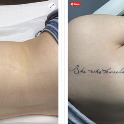 Skin Deep Laser Spa - Only one more treatment to go! No scarring and the ink will be completely gone.