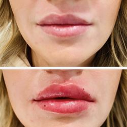 Heather Brown Face and Body Studio - Before and After Lip Injections