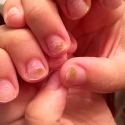 Fungus on 3 of my nails after my second acrylic fill. This was not on my nails before coming to this salon. Fungus on 3 of my nails after my second acrylic fill. This was not on my nails before coming to this salon.