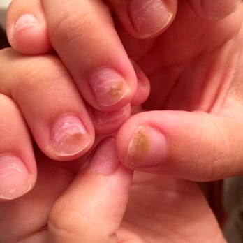 Designs Hair & Nails - Fungus on 3 of my nails after my second acrylic fill. This was not on my nails before coming to this salon. - Hair Salons Near Me - Lake Forest, California Designs Hair & Nails - Fungus on 3 of my nails after my second acrylic fill. This was not on my nails before coming to this salon. - Hair Salons Near Me - Lake Forest, California
