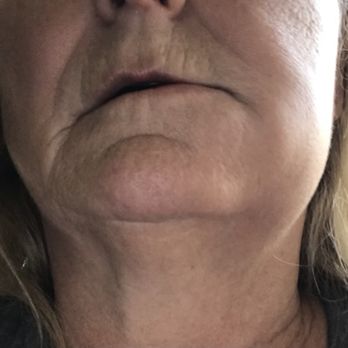 Murrieta Dental Group - Swollen excruciating pain - Cosmetic Dentists Near Me - Murrieta, California Murrieta Dental Group - Swollen excruciating pain - Cosmetic Dentists Near Me - Murrieta, California