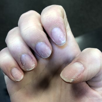 Sky Spa - Does this look painful? It is. This is after a rushed and reckless gel removal. - Skin Care Near Me - Norwood, Massachusetts