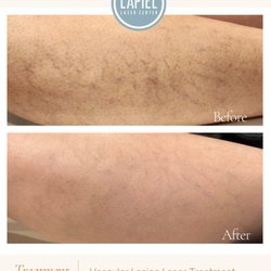 Lapiel Laser Center - Vascular Lesion Treatment