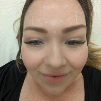 LaserAway - My forehead mapped for xeomin - Tattoo Removal Near Me - Houston, Texas