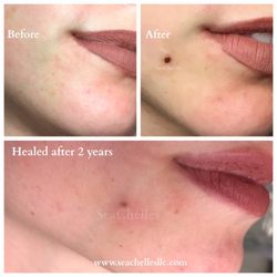 SeaChelle's - Healed created-tattooed-mole