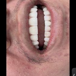 Miami Cosmetic Smile Design - The unnatural looking teeth they made for me that look nothing like the pictures I asked for