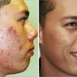 The Best U Now Plastic Surgery - Villani Peel for acne treatments