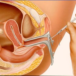 Randy S Morris, MD, SC - IVF1 - Intrauterine insemination (IUI)