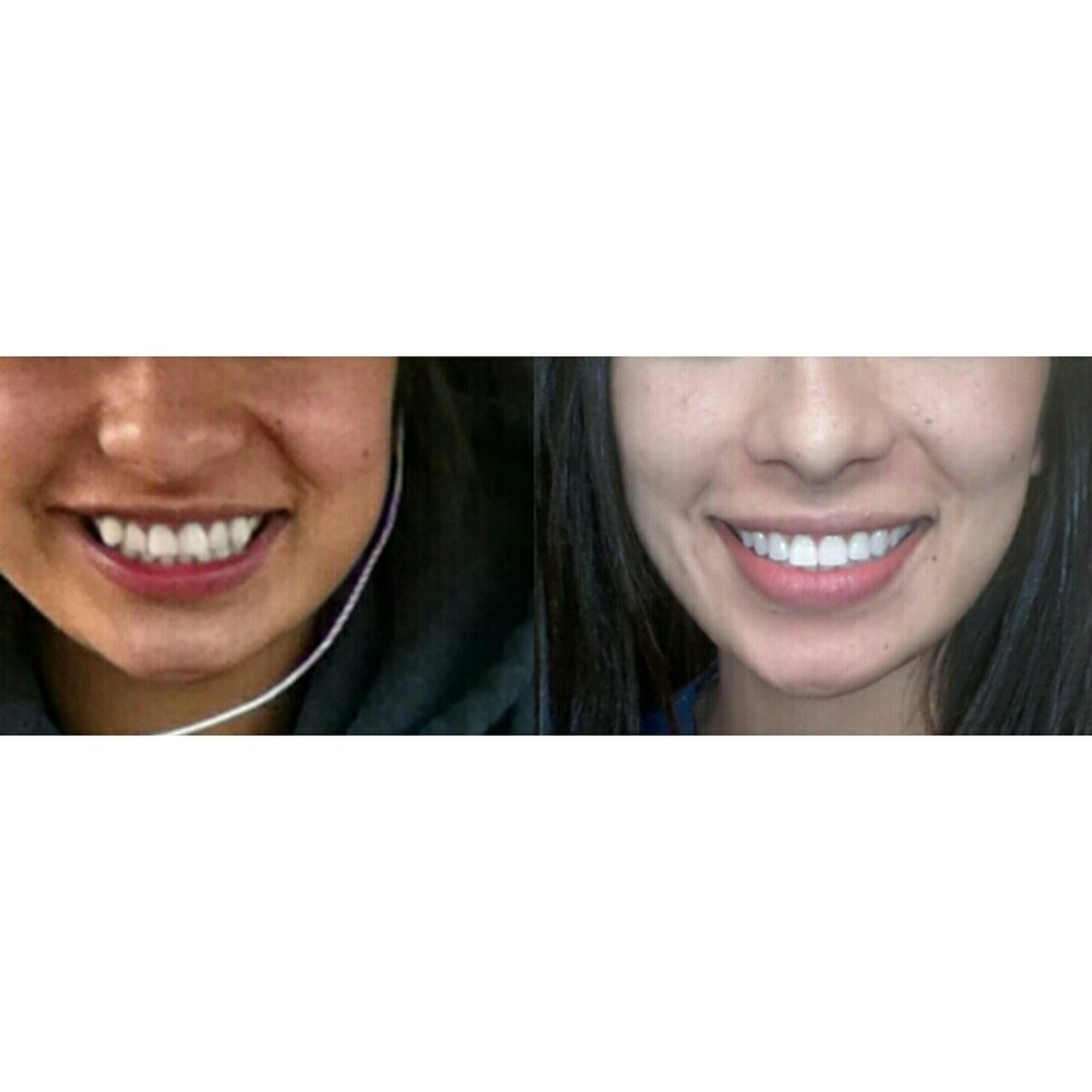 My before and after treatment at North Coast Orthodontics. I'm one happy patient! My before and after treatment at North Coast Orthodontics. I'm one happy patient!