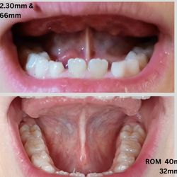 Arrowhead Myo - Range of motion improved by 8mm!