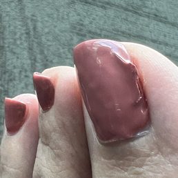 Broken Toe Nail Broken Toe Nail