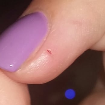Idol Nails - Was cut on 8/5/16 now red. - Nail Salons Near Me - Glens Falls, New York