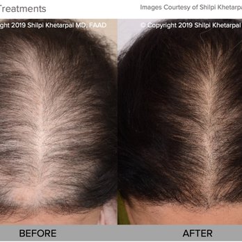 Metroderm DC - Platelet Rich Plasma for Hair Restoration Washington, DC 20006 - Dermatologists Near Me - Washington, DC, District of Columbia