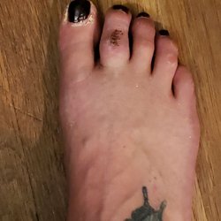 Jackalone John DPM PC - After my surgery.. its still slightly swollen but its still healing.
