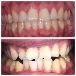 Signature Smiles - Invisalign and bondings