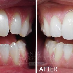 Dental Associates of Hoboken - Porcelain Veneers