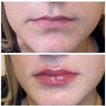 Encore Medspa - Lips done by Jenny I love them :) - Laser Hair Removal Near Me - Walnut Creek, California Encore Medspa - Lips done by Jenny I love them :) - Laser Hair Removal Near Me - Walnut Creek, California