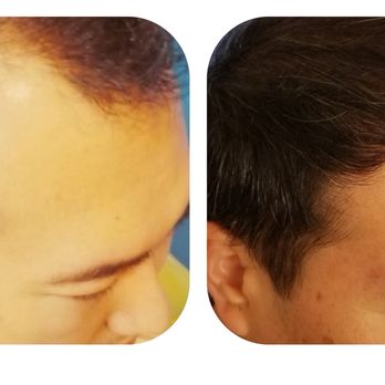 Meshkin Medical - 2000 grafts before and after 6 months - Hair Loss Centers Near Me - Los Angeles, California Meshkin Medical - 2000 grafts before and after 6 months - Hair Loss Centers Near Me - Los Angeles, California