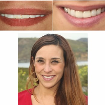 Pacific Coast Dental - Before and after of a patient who chipped her tooth. We were able to replace it with a veneer. - General Dentistry Near Me - Pacifica, California