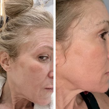 Bodywelle - Hyperpigmentation before (left) and after (right) one intense pulsed light treatment. - Medical Spas Near Me - Miami Beach, Florida Bodywelle - Hyperpigmentation before (left) and after (right) one intense pulsed light treatment. - Medical Spas Near Me - Miami Beach, Florida
