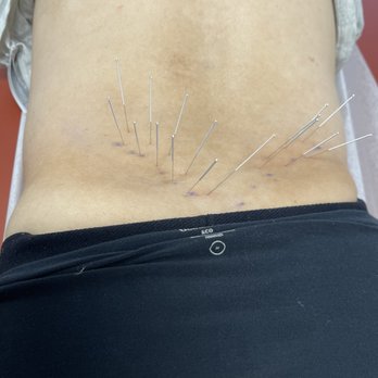 Northridge Acupuncture - We just saw Dr. Lu today. There is no more pain. - Acupuncture Near Me - Reseda, California Northridge Acupuncture - We just saw Dr. Lu today. There is no more pain. - Acupuncture Near Me - Reseda, California