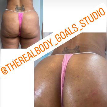 Body Goals Studio - Sculptra Non-Surgical Butt Lift - Medical Spas Near Me - Decatur, Georgia Body Goals Studio - Sculptra Non-Surgical Butt Lift - Medical Spas Near Me - Decatur, Georgia